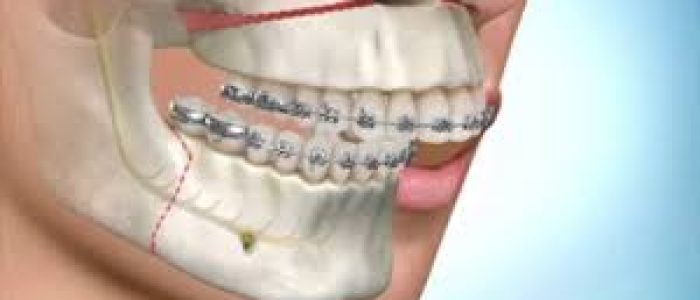 cirurgia ortognatica